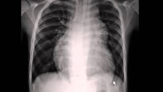 Chest xray  pulmonary arterial hypertension [upl. by Rolland84]