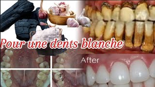 dents blanche comment faire Pour blanchire une dent pourrie en blanche [upl. by Comyns]