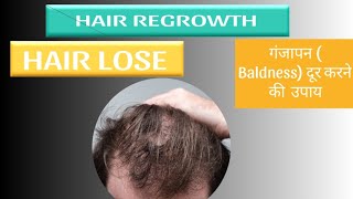 minoxidil hair regrowth results  best minoxidil ebadurhaircaretips [upl. by Nairrot]