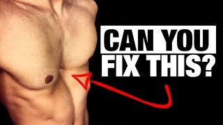 How to Fix a Sunken Chest PECTUS EXCAVATUM [upl. by Honor270]