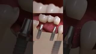 Bridge dentaire sur Implant [upl. by Annohsak]