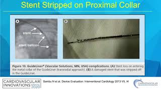 Guide extension complications  Thomas Tsai MD [upl. by Semaj]