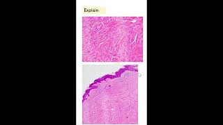 ShortsExam slideselongated cells keloidleiomyoma hyaline change Dr GSS SRM MCH RC [upl. by Elon]