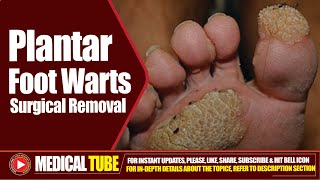 Foot Plantar Warts  Surgical Removal Treatment  How to Remove Plantar Warts ❌🦠 [upl. by Ailem525]