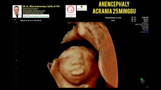 Acrania anencephaly 25 minggu [upl. by Anihs]