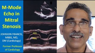 MMode Echo in Mitral Stenosis [upl. by Ttsepmet]