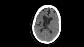 CT Chronic Basal Ganglia infarcts and Anatomy DISCUSSION by Radiologist [upl. by Antonetta736]