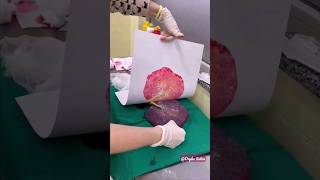 placenta How to remove placenta what is placenta placentapositionduringpregnancy placenta [upl. by Orihakat]