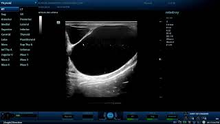 Multiple Epididymal cysts  Diagnostic ultrasound cases [upl. by Still220]