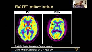 2022 Conference  MRI markers of progression in MSA and How to Diagnose MSA  The New MDS criteria [upl. by Panayiotis]