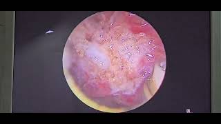 Coblation adenoidectomy  Dr Hitesh Patel [upl. by Terrence]