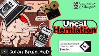 Uncal Herniation [upl. by Yemaj]