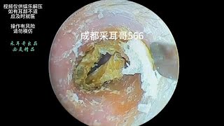 采耳哥Clean dry fungal slices in the ear ｜566 asmr earwax earwaxremoval drzhao [upl. by Seda]