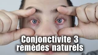 Conjonctivite  3 remèdes naturels pour soulager vos yeux [upl. by Kobe]