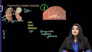 RENAL PATHOLOGY REVISION BY DR PREETI SHARMA [upl. by Rame]