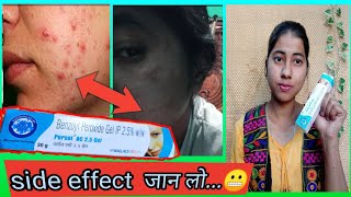 Benzoyl Peroxide Gel 25 Review In Hindi  Uses And Side Effect  miss glossy girl [upl. by Heidy]