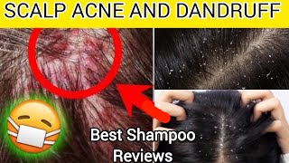 Dandruff amp Itching Shampoo Review – What Really Works [upl. by Ylliw355]