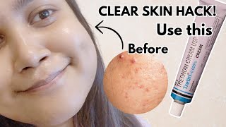 How to Use Tretinoin Correctly Before amp After Results [upl. by Ardelle690]