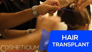 Female DHI Hair Transplantation Without Shaving [upl. by Davon]