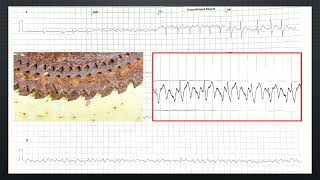 DIAGNOSTIC SIGN IN ECG  TALE OF TACHYCARDIA [upl. by Adniuqal349]