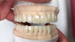 Full Mouth WaxUp Example Case  Dental Lab Learning [upl. by Westphal191]