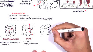 Colorectal Cancer  Overview [upl. by Atteynod]