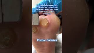 How To Remove Corns Plantar Calluses 😱😆 shorts callusremoval plantarcalluses [upl. by Fogel]