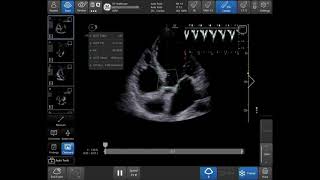 Introducing AutoVTI Tool on Venue™ Family POCUS [upl. by Ettereve]