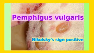 pemphigus vulgaris [upl. by Nivrac]