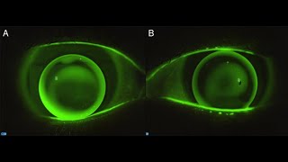 Ideal RGP Lens Fitting Flurosence Pattern ocnseyecareofficial ocns JaivalSheth [upl. by Yssor678]