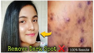 মুখের ব্রণের কালো দাগ দূর হবে মাত্র ১ মাসে 😱  Remove Dark Spot Pigmentation In Just 1 Month [upl. by Shyamal]