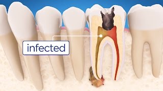 Root Canal Treatment Step by Step [upl. by Annaitat]