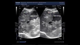 Ultrasound Video showing Hepatic Abscess with a mass [upl. by Adaha]