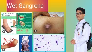 Wet Gangrene Pathology Why Moist Tissues Affected [upl. by Liatrice12]