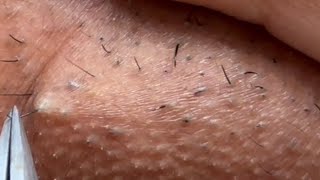 INGROWN HAIR REMOVAL 102  Longest Plucking Video Yet  DermaplaningEyebrow Shaving [upl. by Gayle]