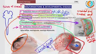 3 Pathology of CNS  Congenital anomalies  للدكتور عبدالرحمن خليفة  لأمراض الجهاز العصبي المركزي [upl. by Harol]