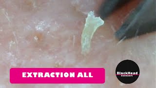 Whitehead and BlackHead RemovalExtraction All [upl. by Leodora]