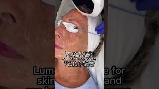 Lumecca Intense Pulsed Light Treatment  Lumecca IPL Near Me  Lumecca Results [upl. by Lamoree173]