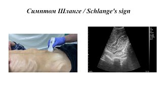 Острая кишечная непроходимость Ранний признак  Симптом Шланге [upl. by Aryan]