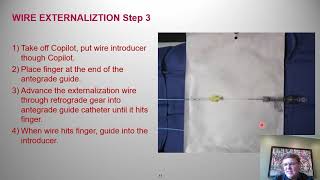 Guidewire externalization Stepbystep  Tony Doing MD [upl. by Shanney]