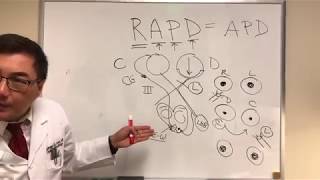 RAPD Relative Afferent Pupillary Defect MarcusGunn pupil [upl. by Laurella23]