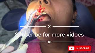 Maxillary first molar extraction  upper first molar extraction youtube dentistry trending [upl. by Ellohcin]