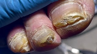 Thick nails every toenail infected with onychomycosis【Pedicure Master Lin Jun】 [upl. by Niabi]