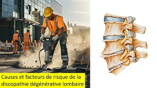 Causes et facteurs de risque de la discopathie dégénérative lombaire [upl. by Brocky276]