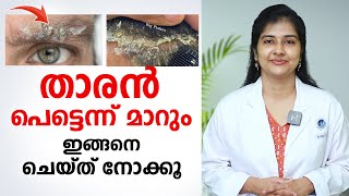 താരൻ പെട്ടെന്ന് മാറും ഇങ്ങനെ ചെയ്താൽ  Dandruff Treatment at Home  DrRadhika SBhat [upl. by Shoemaker]