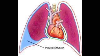 Pleural Effusions  Transudate Exudate amp Lymphatic [upl. by Lavud860]