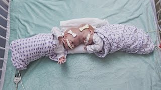 10MonthOld Twins Joined at the Head Successfully Separated [upl. by Kellyn]