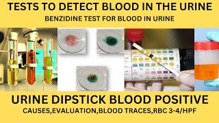 TESTS TO DETECT BLOOD IN THE URINEDIPSTICK BLOOD TRACESRBC 34BENZIDINE TEST FOR BLOOD IN URINE [upl. by Alik]