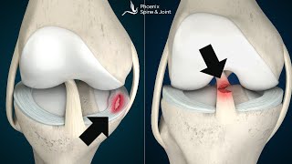 Is your knee pain coming from an ACL tear or Meniscus injury How to tell [upl. by Kcirddot]