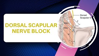 Dorsal Scapular Nerve Injection Technique [upl. by Ahcropal576]